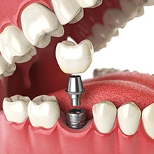 A 3D illustration that shows how dental implants work in Evanston