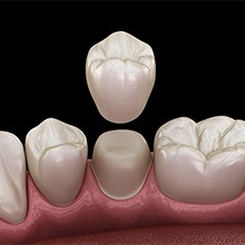 Aniamted dental crown placement