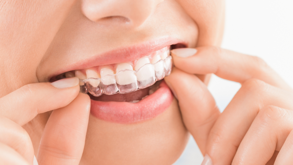 Can You Get Invisalign on Just Your Top Teeth?