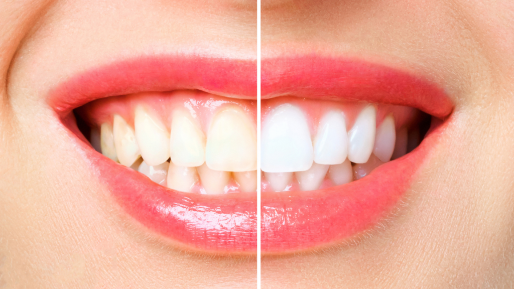 What You Need to Know About Teeth Whitening Products