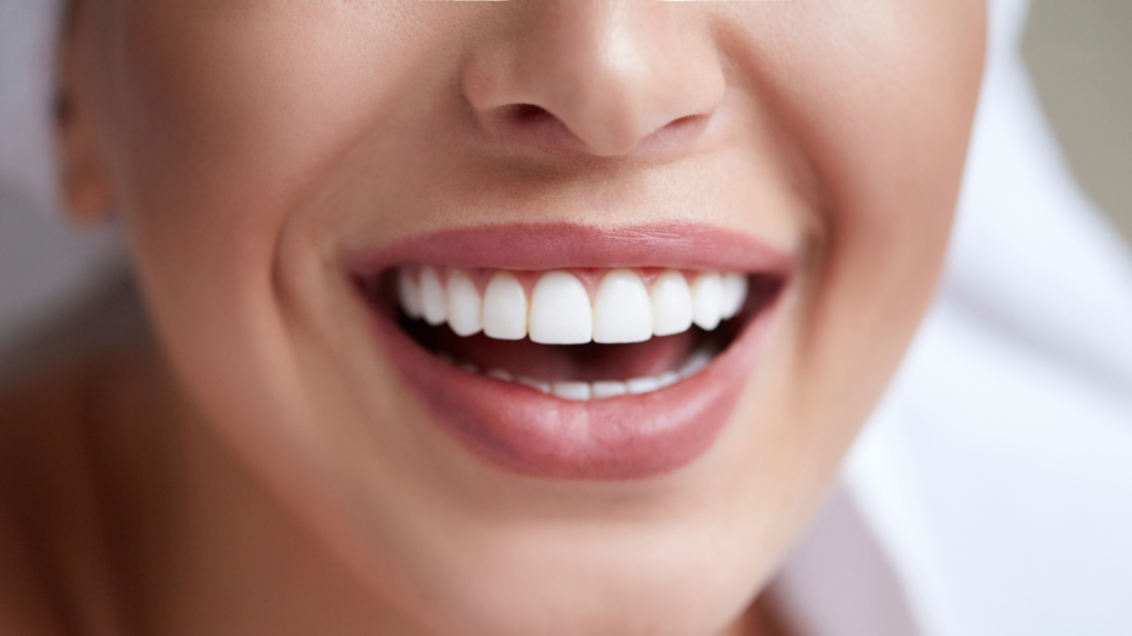 7 Perks of Porcelain Veneers