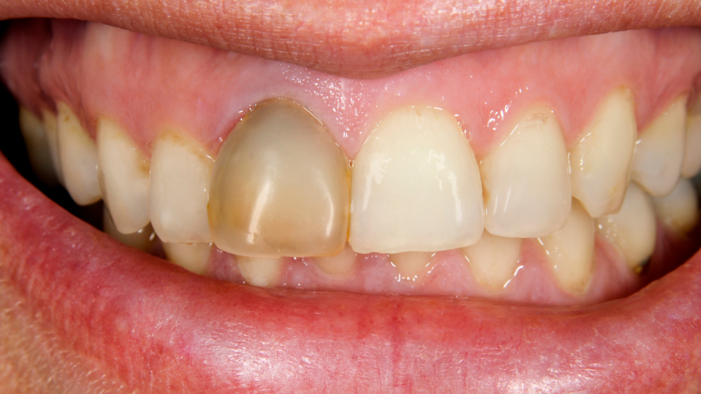 How Long Can You Leave a Dead Tooth?