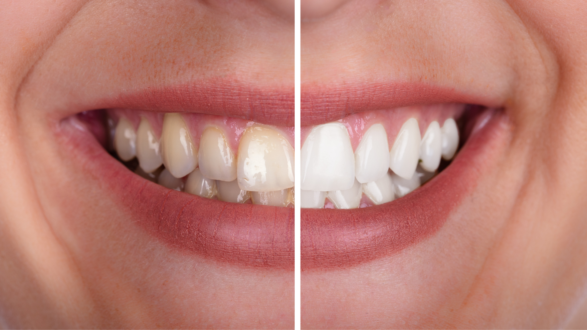 When Should You See a Dentist for Yellow Teeth?