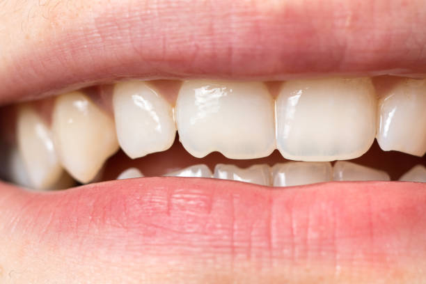 Chipped a Tooth? Here’s What to Do Right Away
