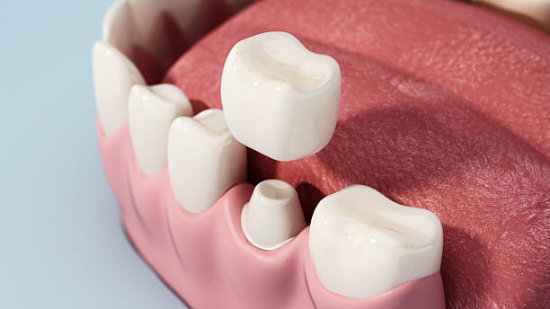 Everything You Need to Know About Same-Day Dental Crowns